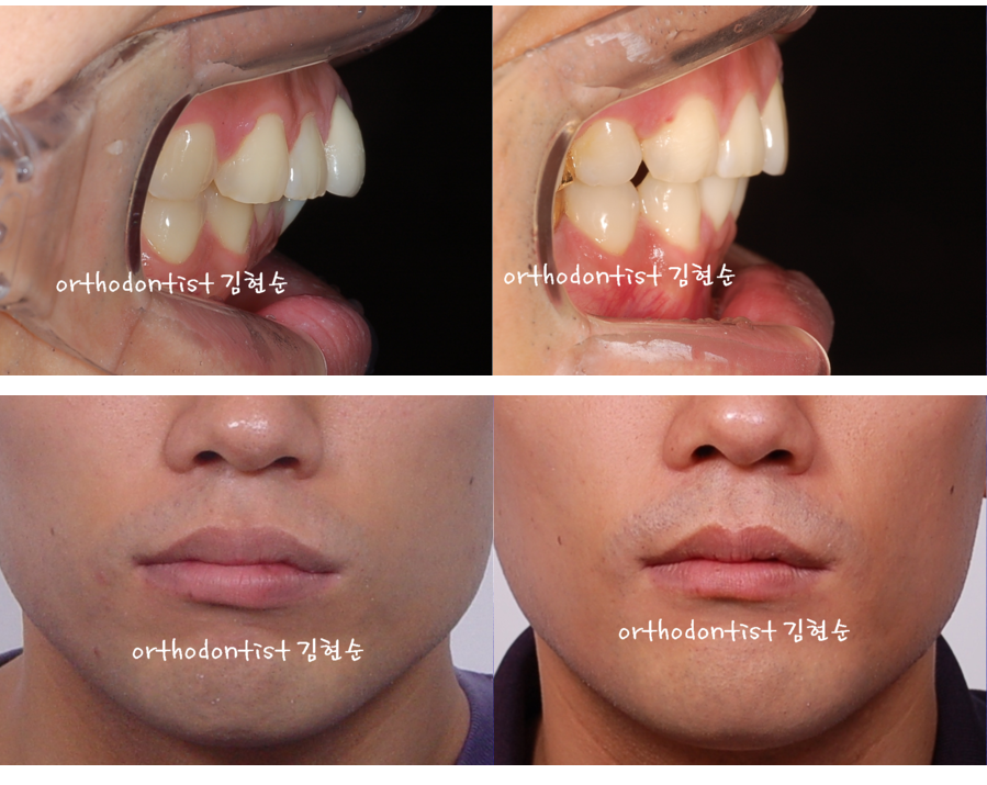 세라믹교정 세라믹치과-돌출입발치교정 1 관련 이미지 8