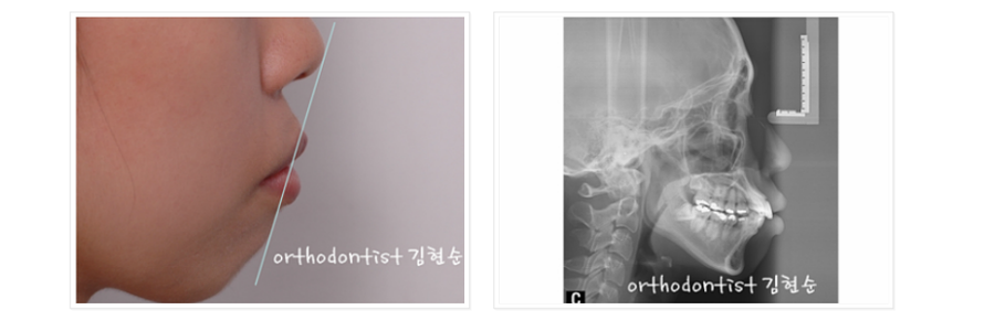 돌출입 발치교정, 미니스크류를 통한 6가지 변화 관련 이미지 6
