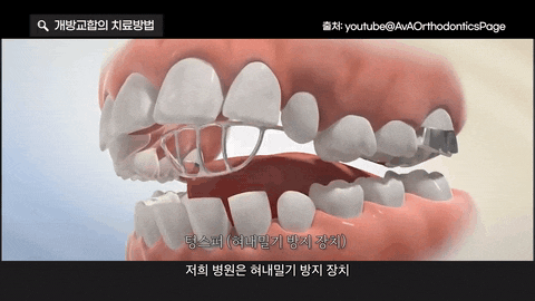 개방교합이란? 앞니와 어금니 상태에 따라 달라지는 교정 방향 관련 이미지 5