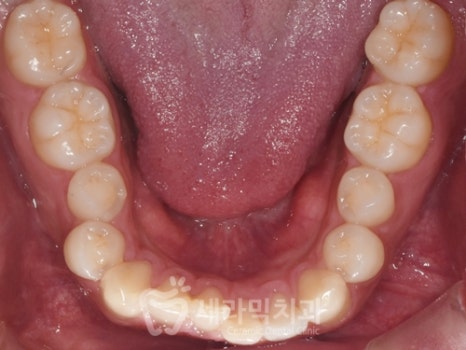 A Case of Overretained Teeth and Deep Bite Orthodontics That Helped the Patient Smile Confidently Before and After image 8