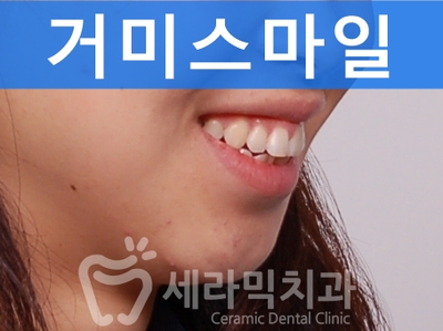 무턱교정, 거미스마일 교정 잘하는 학동역 세라믹치과 관련 이미지 2