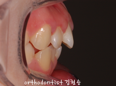 강남 돌출 관련 이미지 19