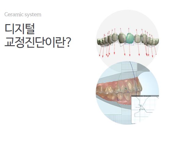 세라믹교정은 세라믹치과 관련 이미지 1