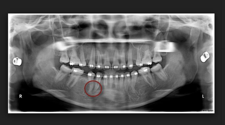 치아교정 부작용 뿌리흡수 관련 이미지 3