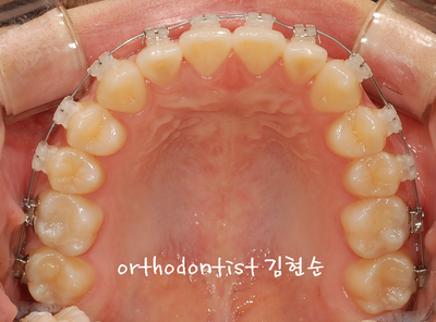 반대 교합 관련 이미지 18