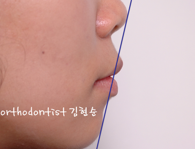 강남 돌출 관련 이미지 8