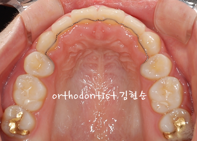 강남 돌출 관련 이미지 32