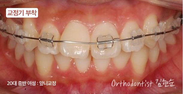 강남치아교정 브라켓비교분석 관련 이미지 18