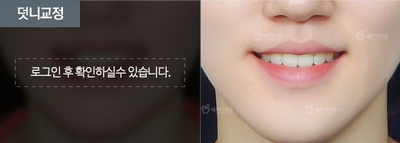 강남 세라믹 치아교정 잘하는곳, 세라믹치과 관련 이미지 2