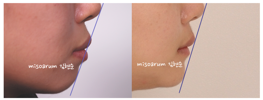 발치 돌출입교정으로 인상개선, 동안 만들기 관련 이미지 9