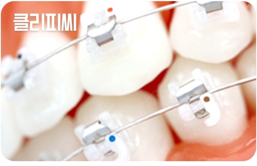 세라믹교정 클리피씨 데이몬 차이점 요약 관련 이미지 5