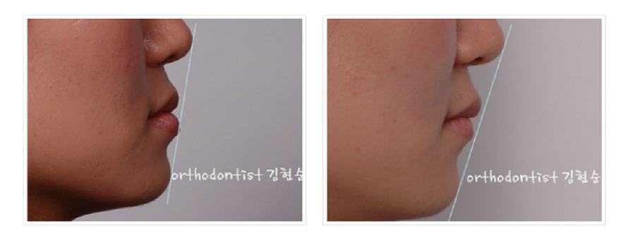 주걱턱수술 안하고 양악수술 안하고 관련 이미지 17