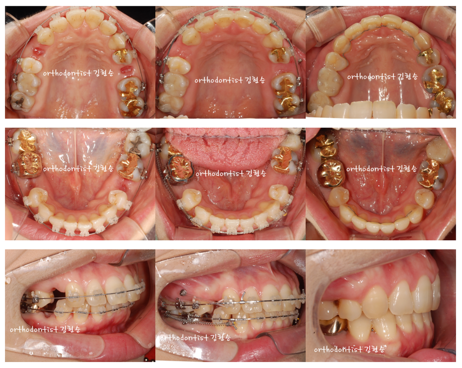 세라믹교정 세라믹치과-돌출입발치교정 10 관련 이미지 5