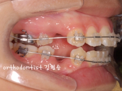 강남치아교정추천 관련 이미지 20