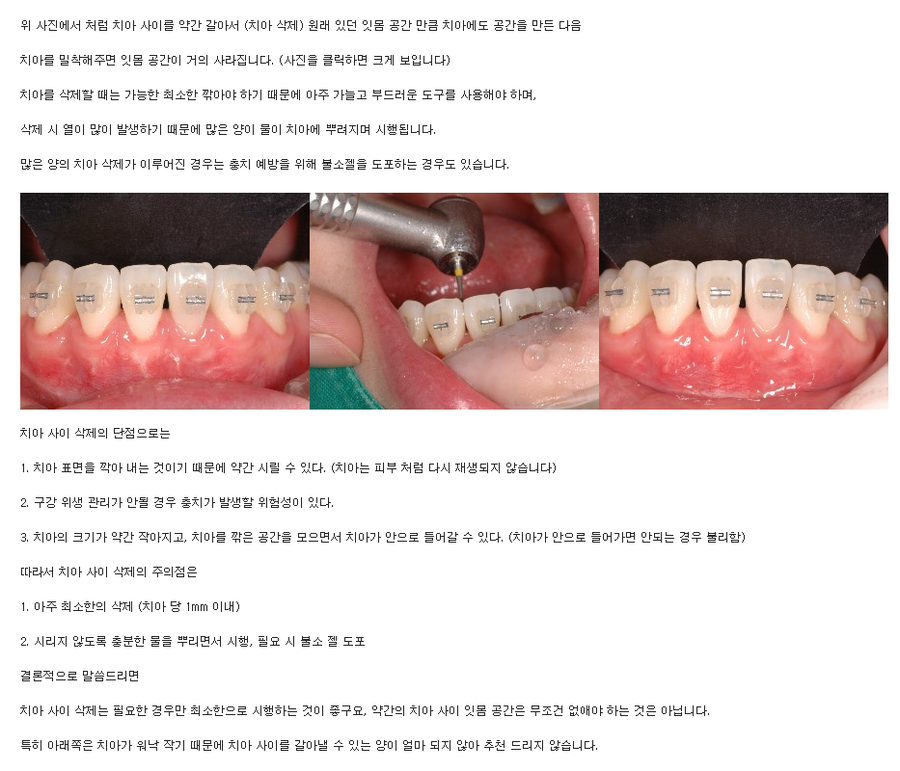 앞니가 돌출된 경우, 발치 교정 후 블랙 트라이앵글(치아 사이 공간) 삭제 관련 이미지 5