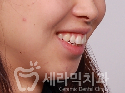 무턱교정, 거미스마일 교정 잘하는 학동역 세라믹치과 관련 이미지 5