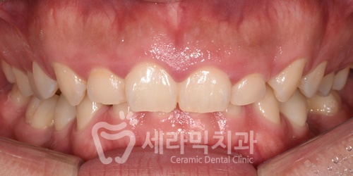 과개교합, 거미스마일, 치아 벌어짐까지 한번에! 치아교정전후 살펴보기 관련 이미지 1