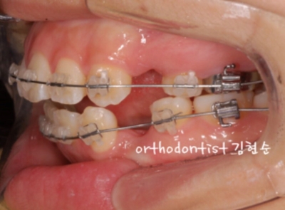 강남치아교정추천 관련 이미지 23