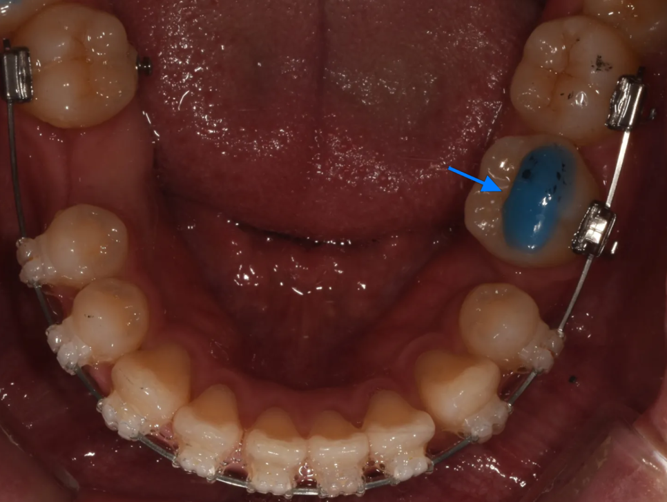 돌출입 교정 전후, 그런데 과개교합까지 있으셨던 환자분 관련 이미지 18