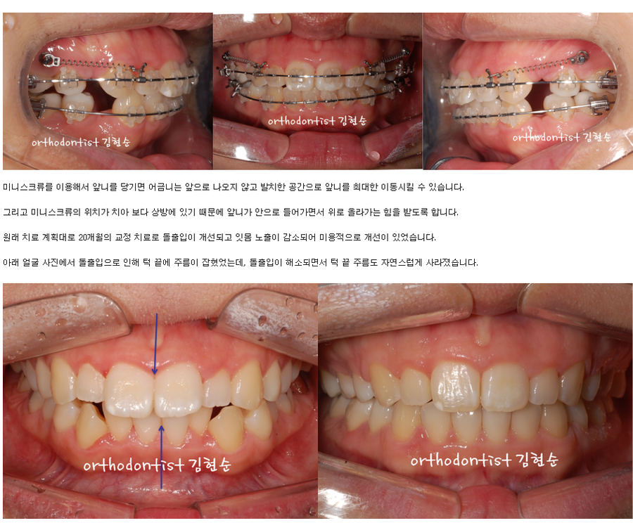 세라믹교정 세라믹치과-돌출입발치교정 5 관련 이미지 5