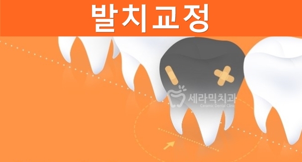 옥니 없이 치아교정잘하는곳, 강남 세라믹치과 관련 이미지 3