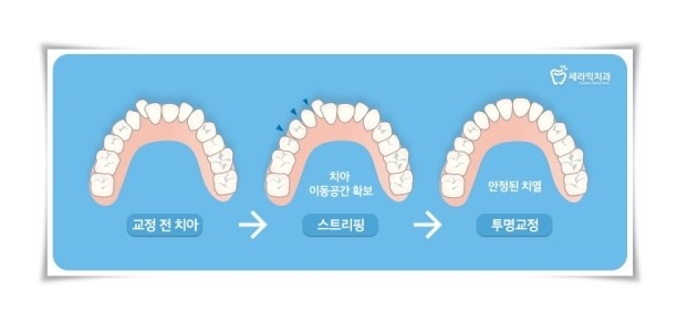 앞니투명교정  6개월이면 ok ! 관련 이미지 6