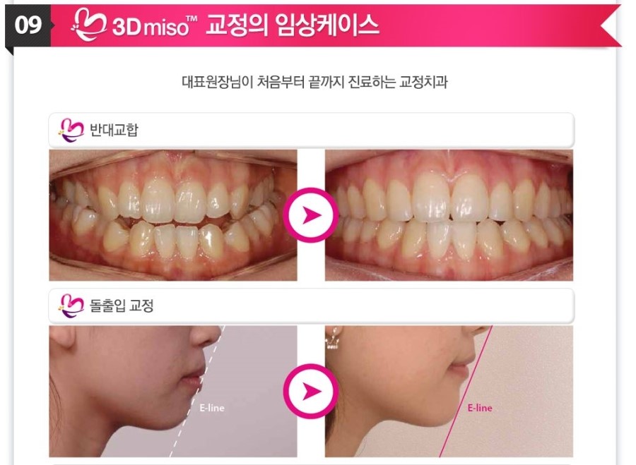 [ 학동역 치과 ] 투명교정의 새이름 3D miso 교정 관련 이미지 11