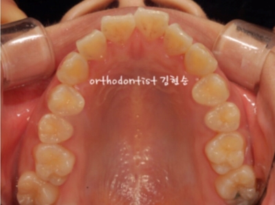 강남치아교정추천 관련 이미지 4