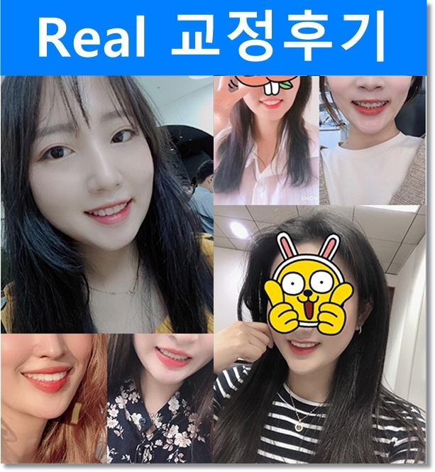 치아 재교정 치아교정전후 되찾은 밝은 미소! 관련 이미지 4