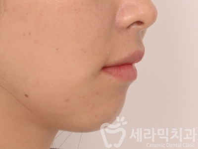 무턱교정, 거미스마일 교정 잘하는 학동역 세라믹치과 관련 이미지 7