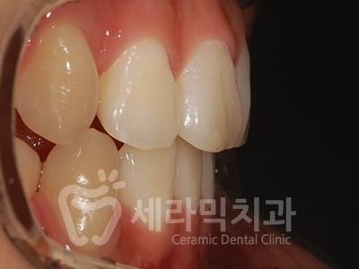 돌출입 덧니 비대칭 치아교정 전후 인상변화! 관련 이미지 21