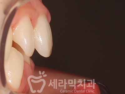 과개교합 치아교정잘하는곳, 세라믹치과 치아교정전후! 관련 이미지 15
