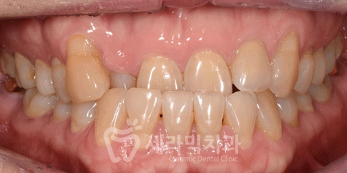 40대에 이어 50대 치아교정 전후사례 증가 추세 관련 이미지 14