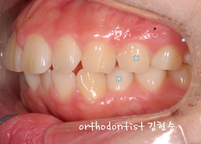 강남 돌출 관련 이미지 17