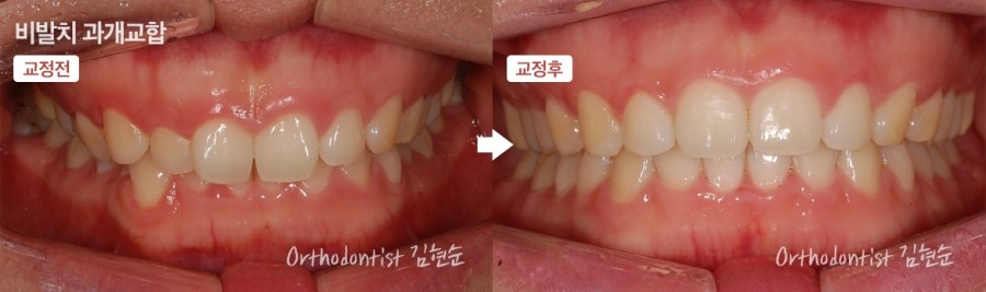 과개교합 무턱 개선 관련 이미지 11