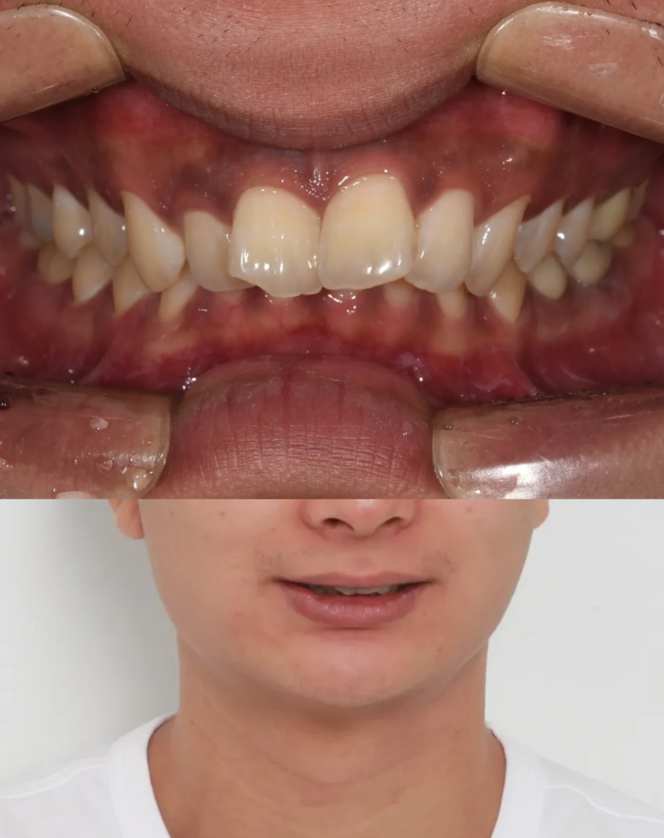 20대 남성의 토끼이빨 교정 – 소구치 발치 없이 관련 이미지 2