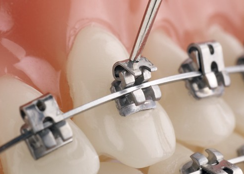 클리피씨, 데이몬 클리어 자가결찰 교정장치 비교 (2026 최신) 관련 이미지 1