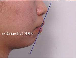 강남 돌출입 교정 관련 이미지 8