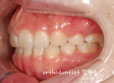 강남 돌출 관련 이미지 31