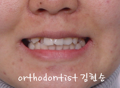 강남 돌출 관련 이미지 3