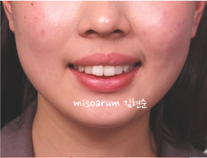 강남 돌출입 교정 관련 이미지 2