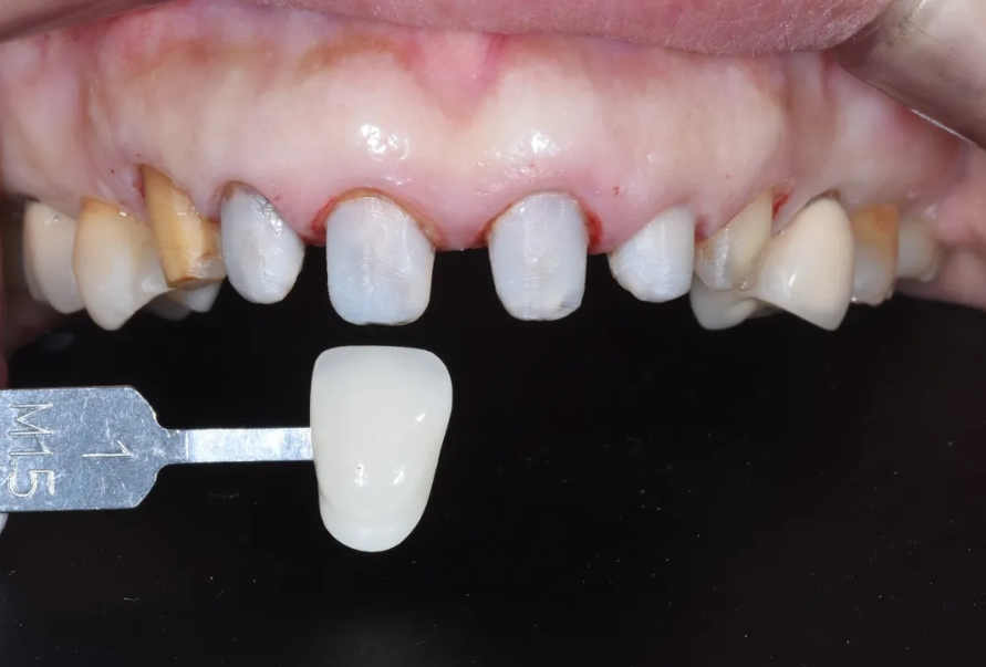 일본에서 거절당했던 앞니 심미보철 크라운 관련 이미지 10