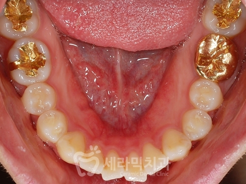 20대 돌출입교정, 무턱교정, 치아교정전후 세련된 얼굴 라인을 되찾다! 관련 이미지 8