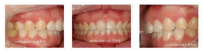 과개교합 ABP 교정 관련 이미지 12
