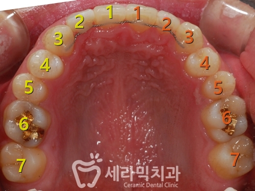 돌출입 투명교정 치아교정전후 관련 이미지 1