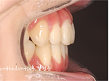 강남 돌출입 교정 관련 이미지 14