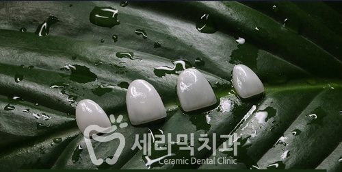 치아교정과 라미네이트는 선택이 아닌 상호 보완관계! 관련 이미지 3