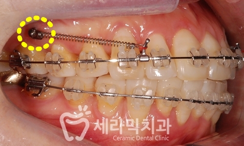 성인교정, 40대 50대 치아교정 잘하는 세라믹치과 치아교정전후 관련 이미지 4