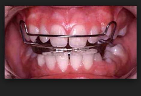 안면비대칭 치료 치아교정으로만 가능한 경우 관련 이미지 4