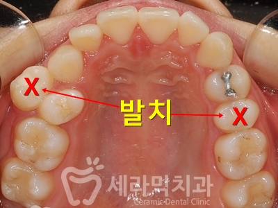 과개교합 치아교정잘하는곳, 세라믹치과 치아교정전후! 관련 이미지 19